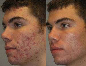 Best Acne Treatment in Edmonton | Oxyderm Laser Clinic